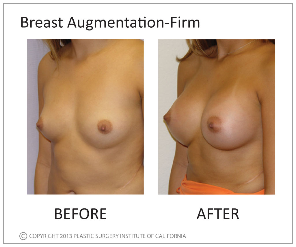 Breast Augmentation Before and After Photo by Plastic Surgery Institute of California in Huntington Beach, CA
