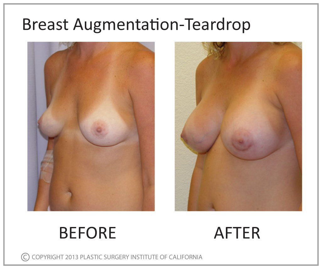 Breast Augmentation Before and After Photo by Plastic Surgery Institute of California in Huntington Beach, CA