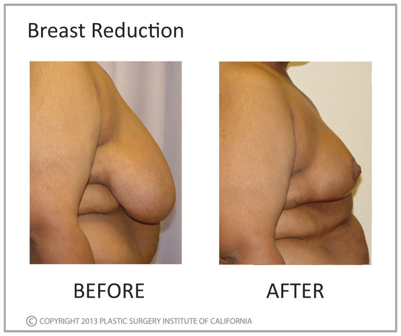 Breast Reduction Before and After Photo by Plastic Surgery Institute of California in Huntington Beach, CA
