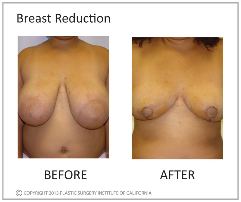 Breast Reduction Before and After Photo by Plastic Surgery Institute of California in Huntington Beach, CA