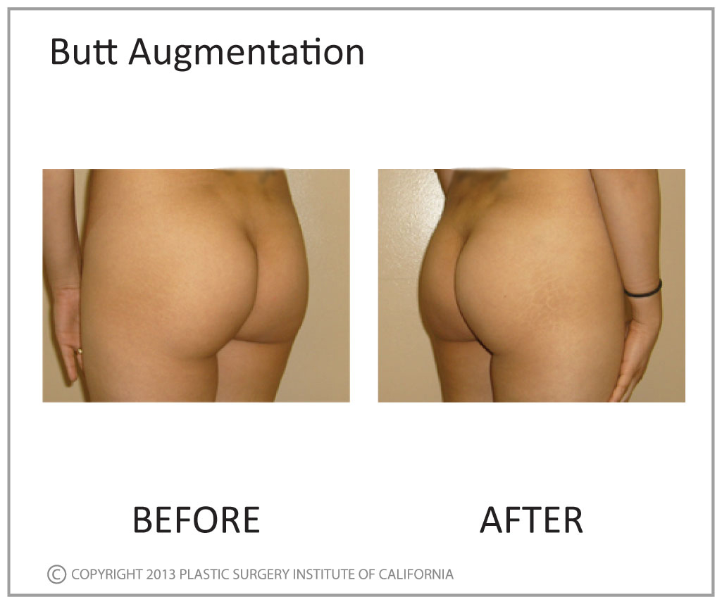 Brazilian Butt Augmentation Before and After Photo by Plastic Surgery Institute of California in Huntington Beach, CA