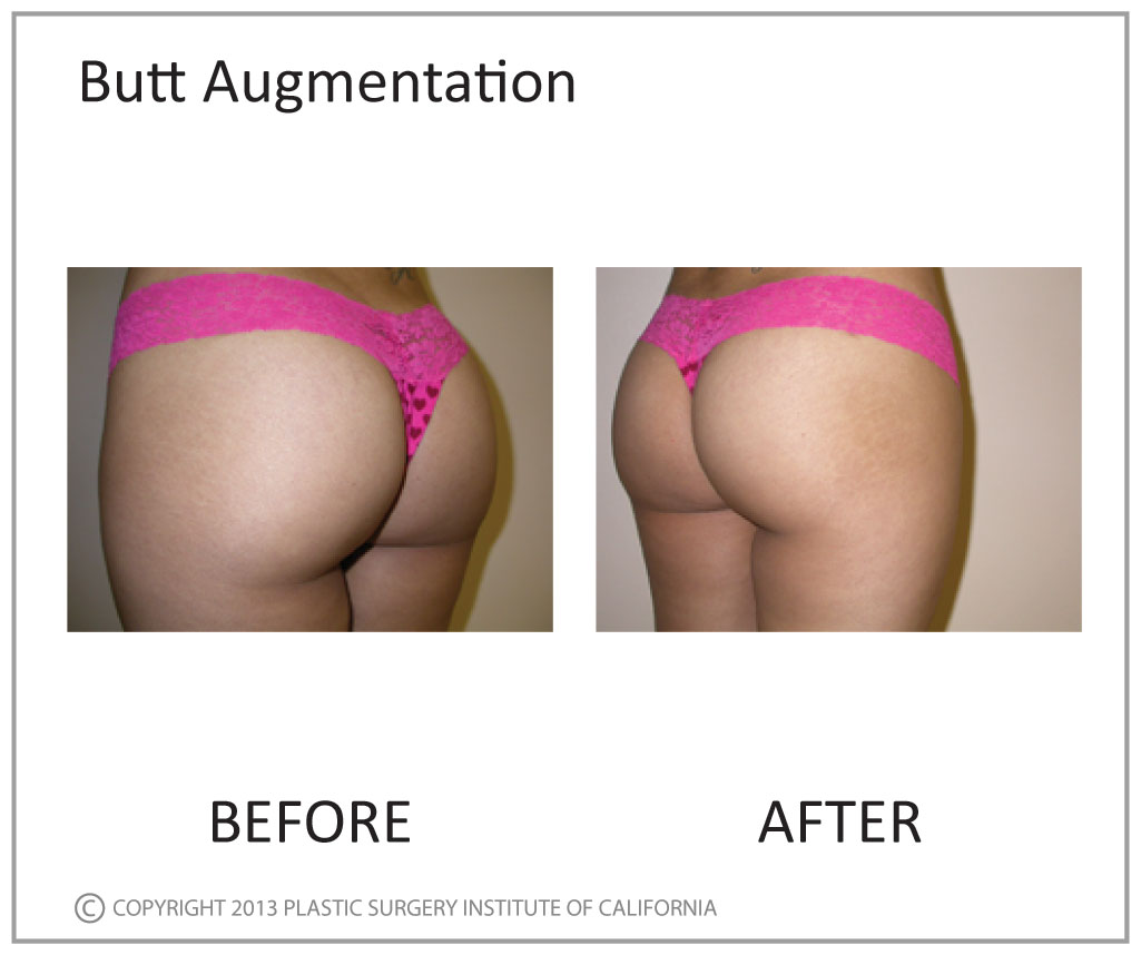 Brazilian Butt Augmentation Before and After Photo by Plastic Surgery Institute of California in Huntington Beach, CA