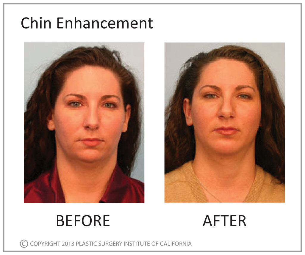 Chin Enhancement Before and After Photo by Plastic Surgery Institute of California in Huntington Beach, CA