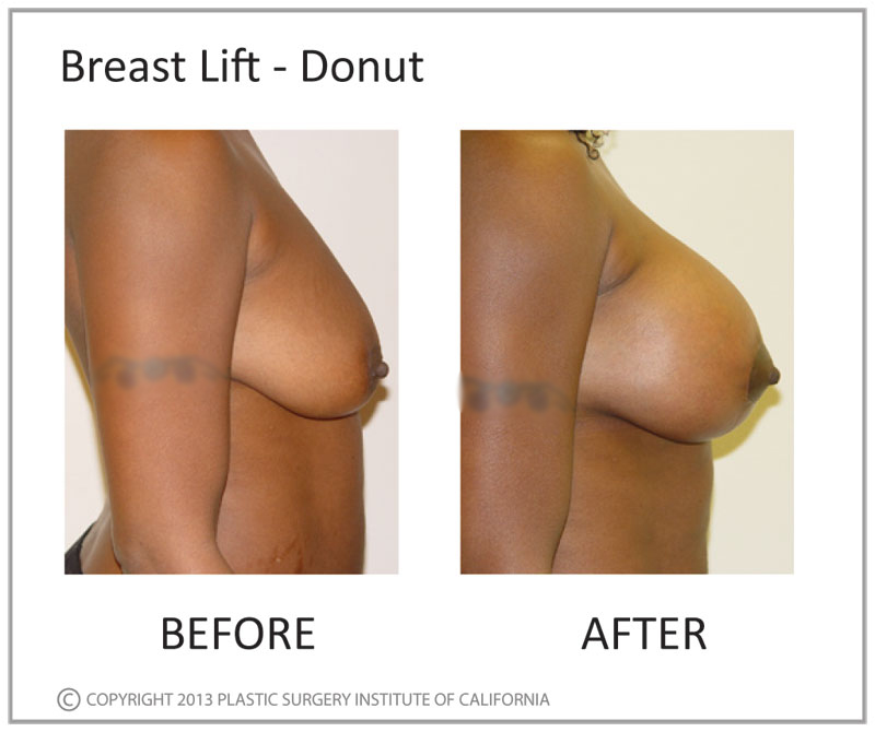 Breast Lift Before and After Photo by Plastic Surgery Institute of California in Huntington Beach, CA