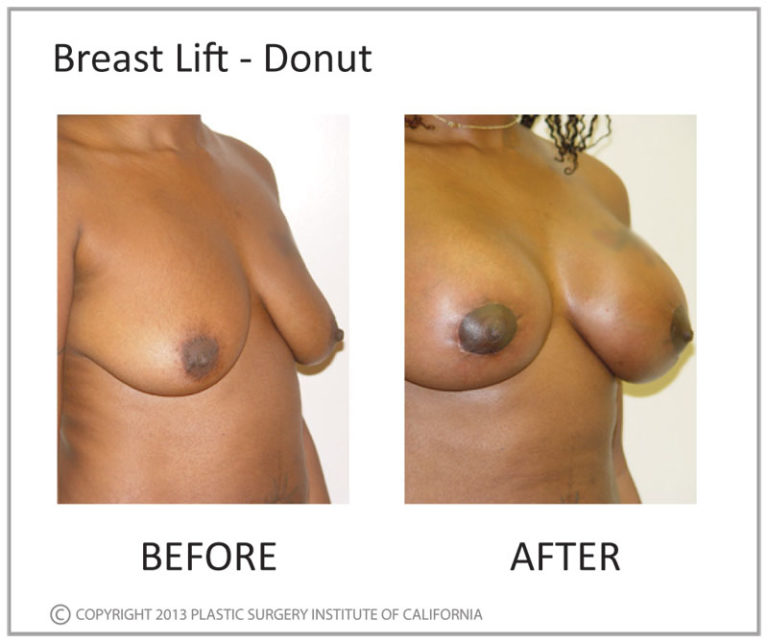 Breast Lift Before and After Photo by Plastic Surgery Institute of California in Huntington Beach, CA Breast Lift Before and After Photo by Plastic Surgery Institute of California in Huntington Beach, CA