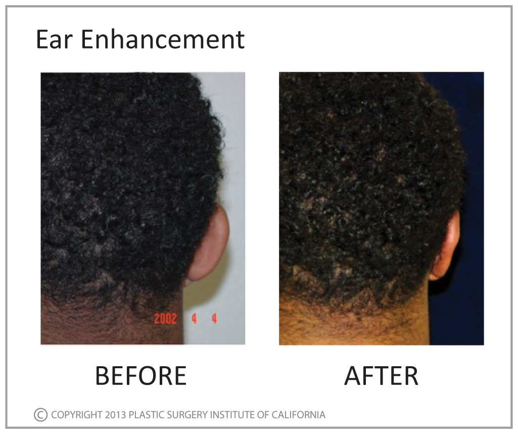 Ear Enhancement Before and After Photo by Plastic Surgery Institute of California in Huntington Beach, CA