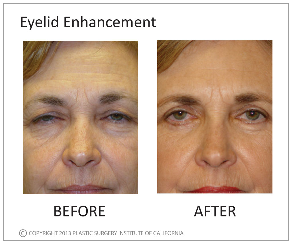 Eyelid Enhancement Before and After Photo by Plastic Surgery Institute of California in Huntington Beach, CA