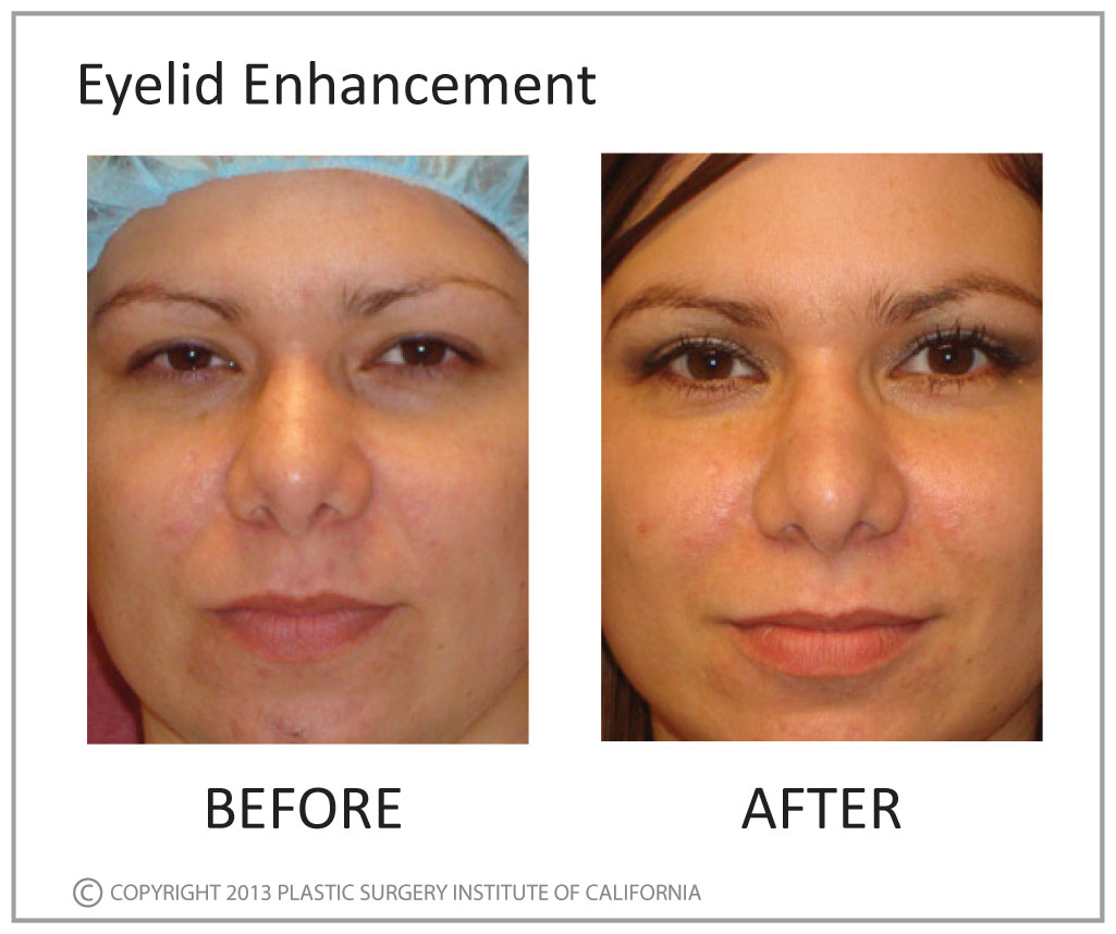 Eyelid Enhancement Before and After Photo by Plastic Surgery Institute of California in Huntington Beach, CA