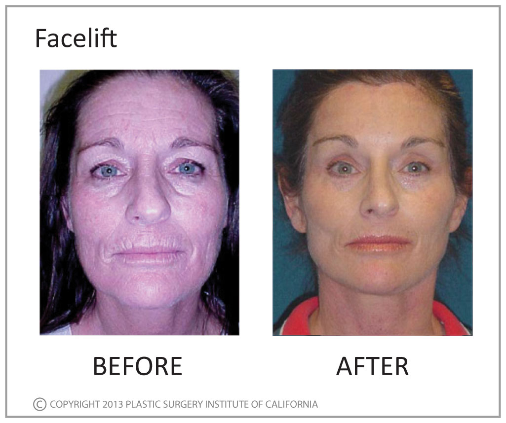 Facelift Before and After Photo by Plastic Surgery Institute of California in Huntington Beach, CA