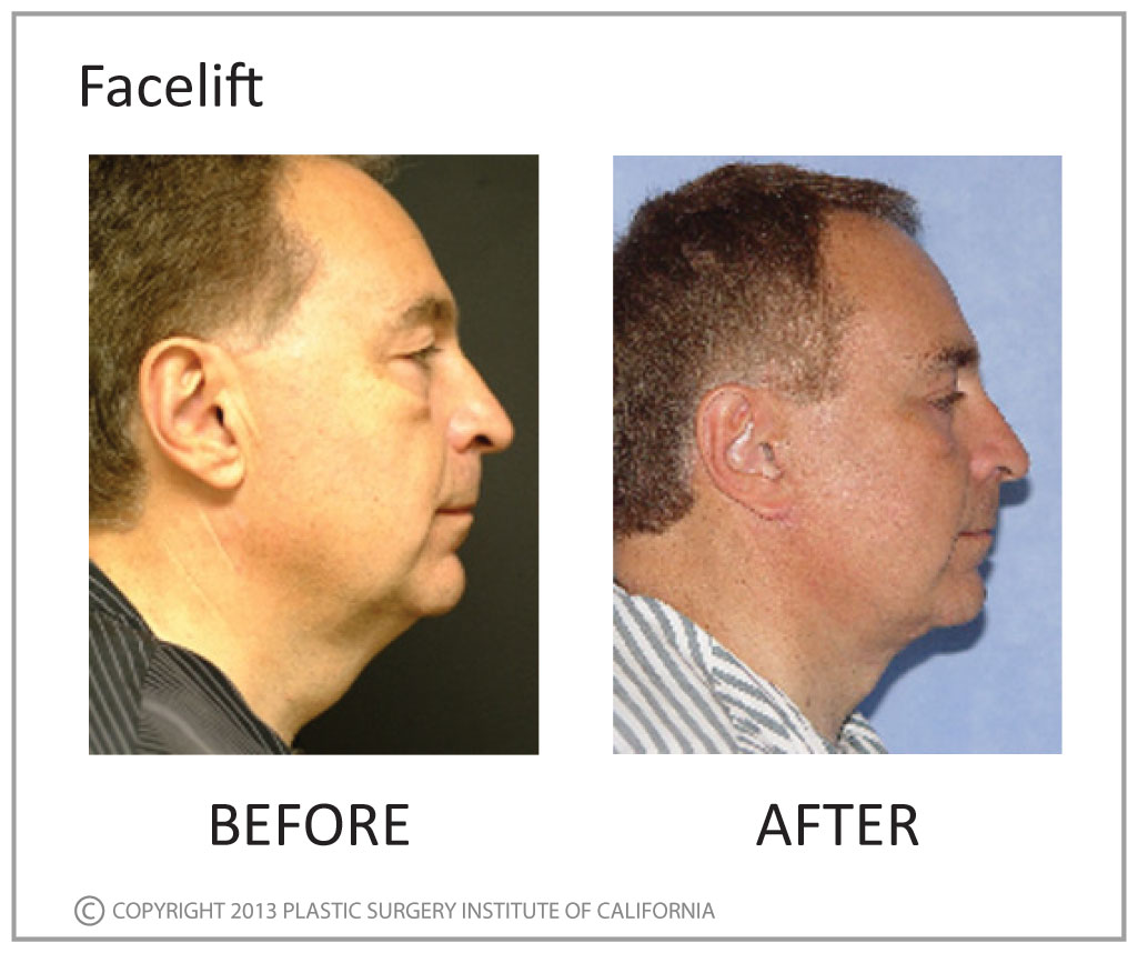 Facelift Before and After Photo by Plastic Surgery Institute of California in Huntington Beach, CA