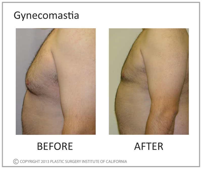 Gynecomastia Before and After Photo by Plastic Surgery Institute of California in Huntington Beach, CA