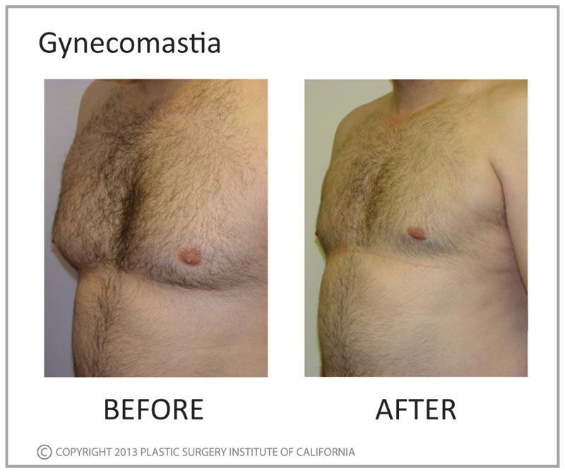 Gynecomastia Before and After Photo by Plastic Surgery Institute of California in Huntington Beach, CA
