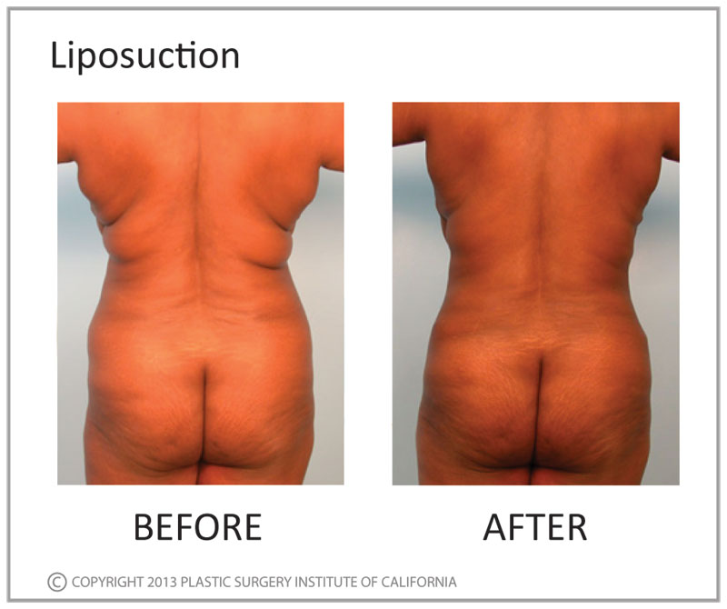 Liposuction Before and After Photo by Plastic Surgery Institute of California in Huntington Beach, CA