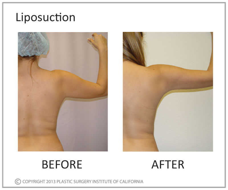 Liposuction Before and After Photo by Plastic Surgery Institute of California in Huntington Beach, CA