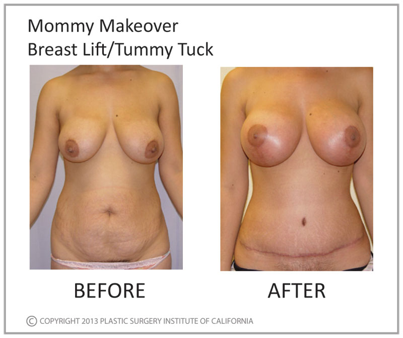 Mommy Makeover Before and After Photo by Plastic Surgery Institute of California in Huntington Beach, CA