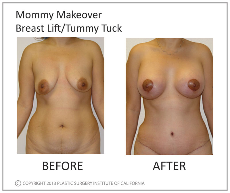 Mommy Makeover Before and After Photo by Plastic Surgery Institute of California in Huntington Beach, CA