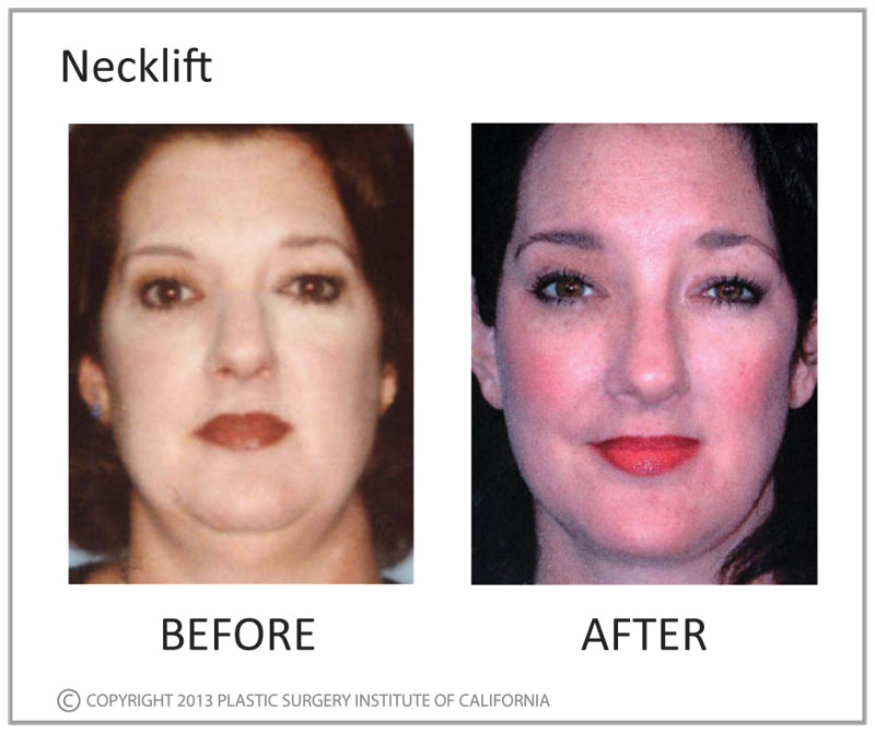 Neck Lift Before and After Photo by Plastic Surgery Institute of California in Huntington Beach, CA