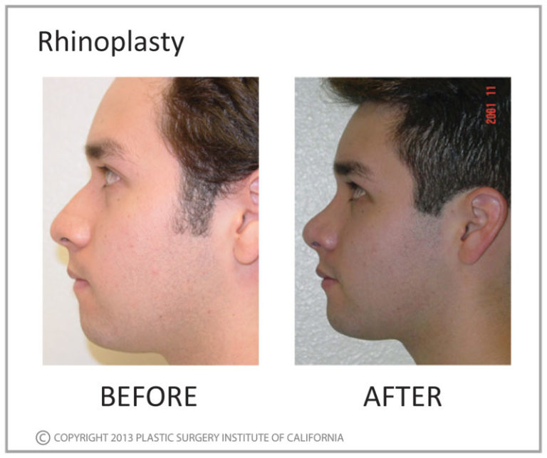 Rhinoplasty Before and After Photo by Plastic Surgery Institute of California in Huntington Beach, CA