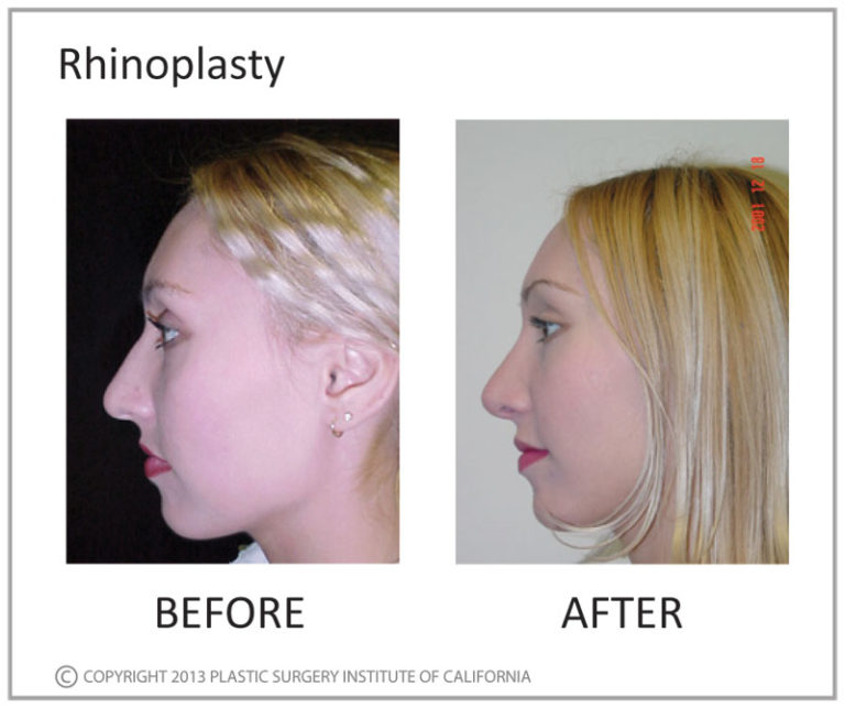 Rhinoplasty Before and After Photo by Plastic Surgery Institute of California in Huntington Beach, CA