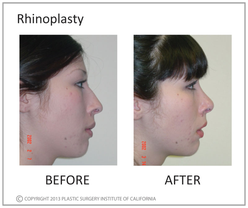 Rhinoplasty Before and After Photo by Plastic Surgery Institute of California in Huntington Beach, CA