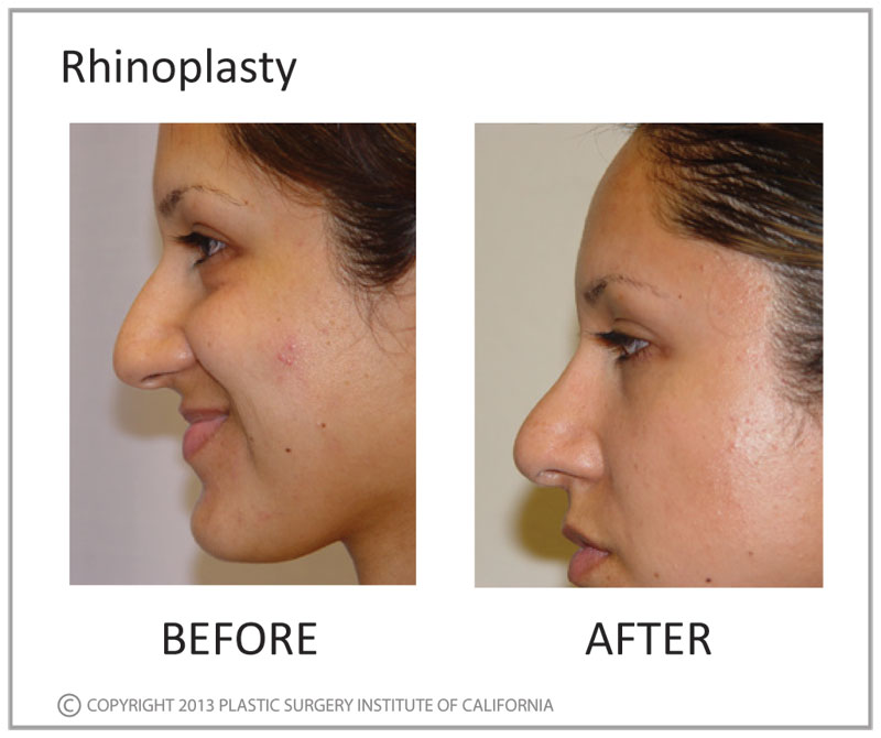 Rhinoplasty Before and After Photo by Plastic Surgery Institute of California in Huntington Beach, CA