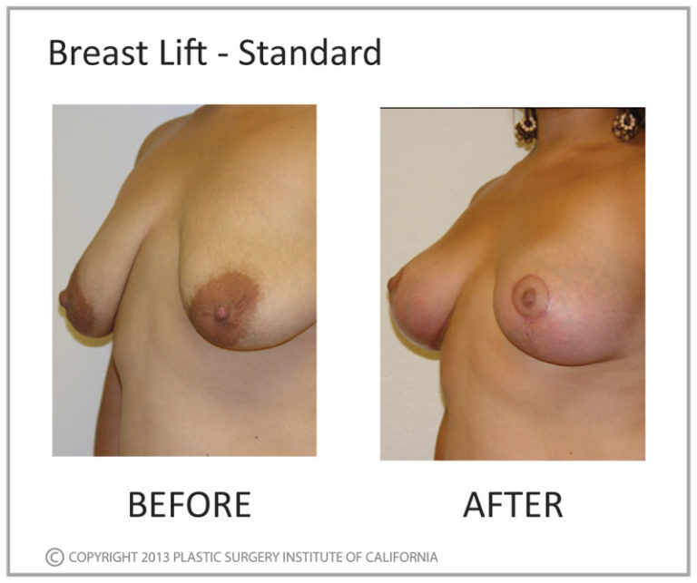 Breast Lift Before and After Photo by Plastic Surgery Institute of California in Huntington Beach, CA Breast Lift Before and After Photo by Plastic Surgery Institute of California in Huntington Beach, CA