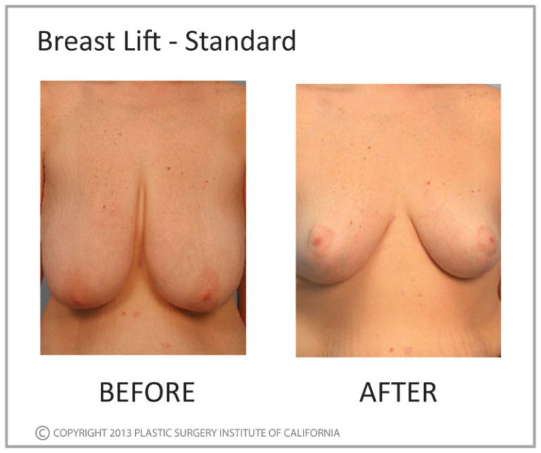 Breast Lift Before and After Photo by Plastic Surgery Institute of California in Huntington Beach, CA Breast Lift Before and After Photo by Plastic Surgery Institute of California in Huntington Beach, CA