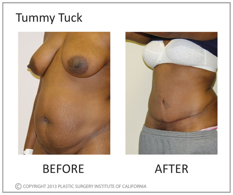 Tummy Tuck Before and After Photo by Plastic Surgery Institute of California in Huntington Beach, CA