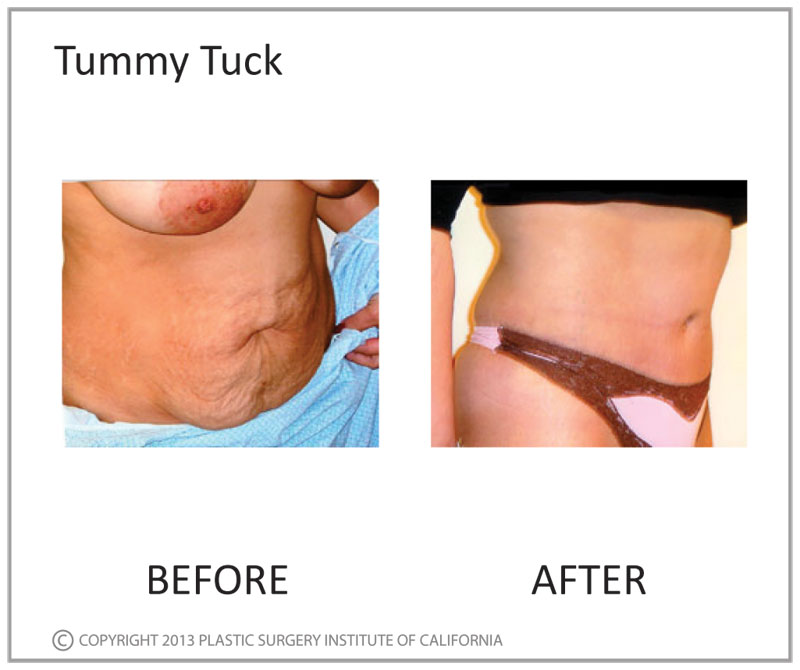 Tummy Tuck Before and After Photo by Plastic Surgery Institute of California in Huntington Beach, CA