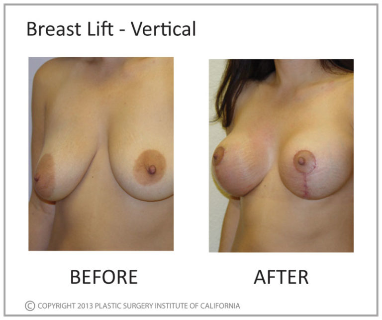 Breast Lift Before and After Photo by Plastic Surgery Institute of California in Huntington Beach, CA Breast Lift Before and After Photo by Plastic Surgery Institute of California in Huntington Beach, CA