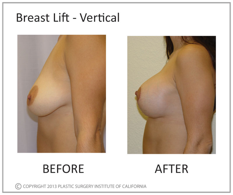Breast Lift Before and After Photo by Plastic Surgery Institute of California in Huntington Beach, CA