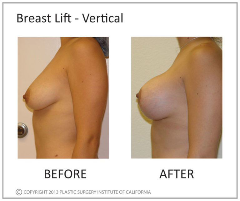 Breast Lift Before and After Photo by Plastic Surgery Institute of California in Huntington Beach, CA Breast Lift Before and After Photo by Plastic Surgery Institute of California in Huntington Beach, CA