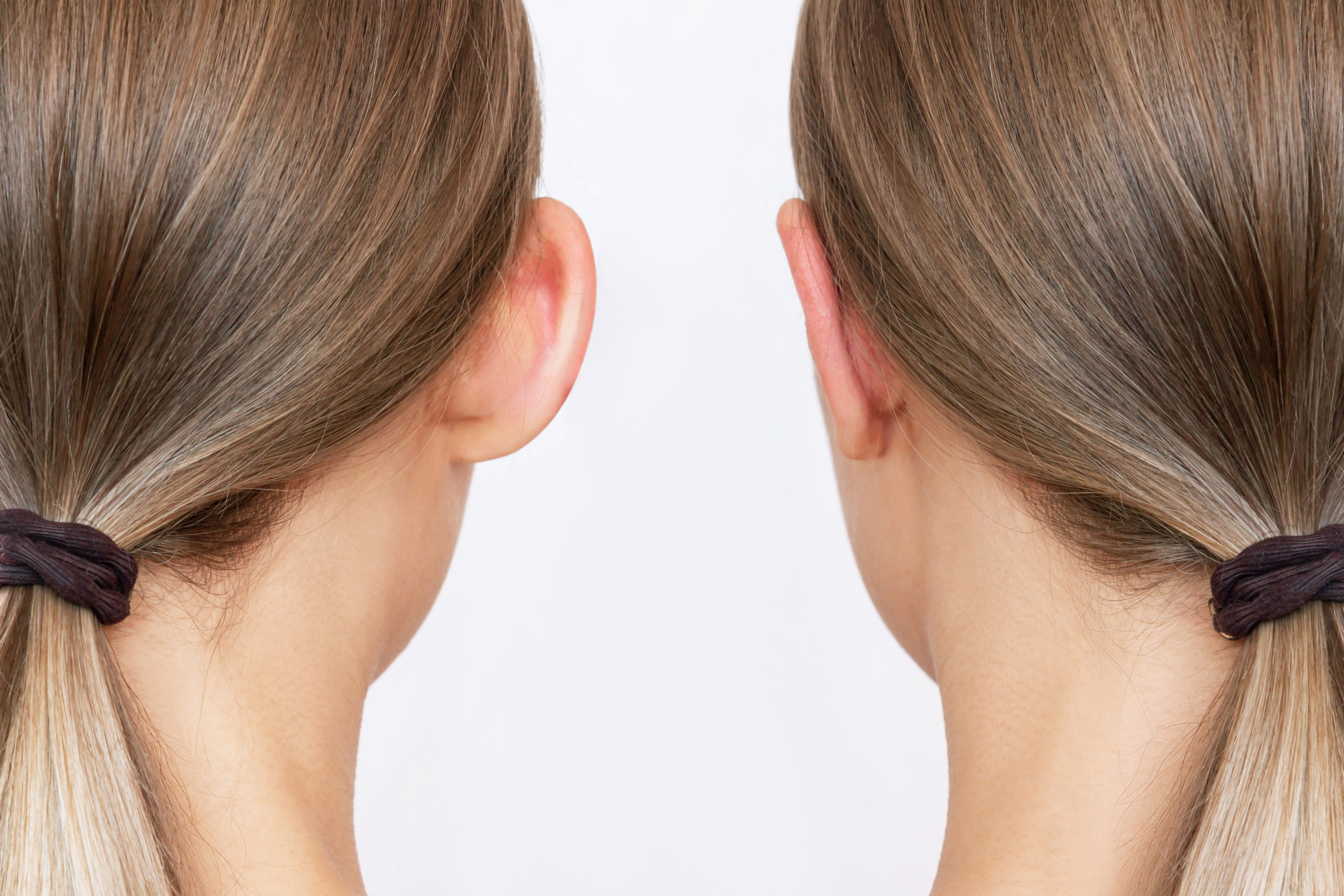 Cropped shot of woman's head with ears before and after otoplasty