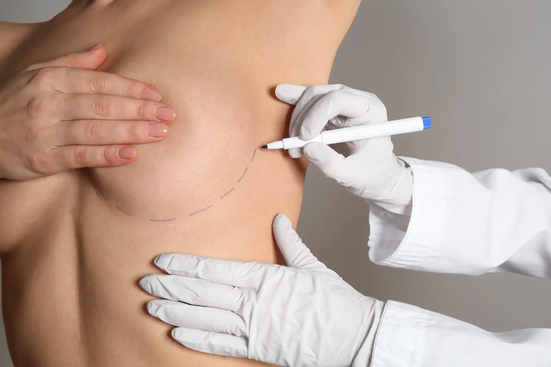Doctor drawing marks on female breast before cosmetic surgery Doctor drawing marks on female breast before cosmetic surgery